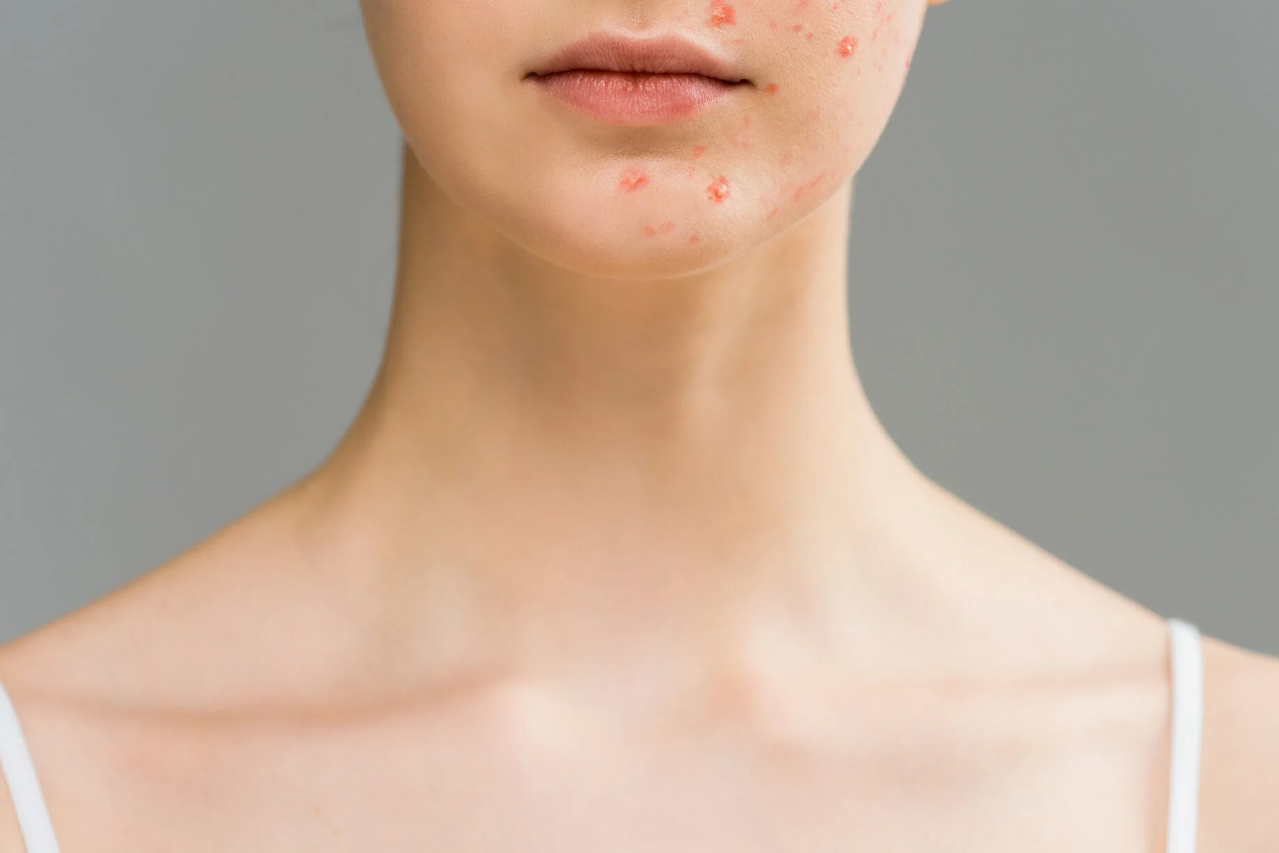 Invloed hormonen op acne