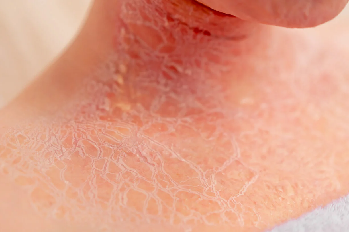 Voordelen Hydrocortison