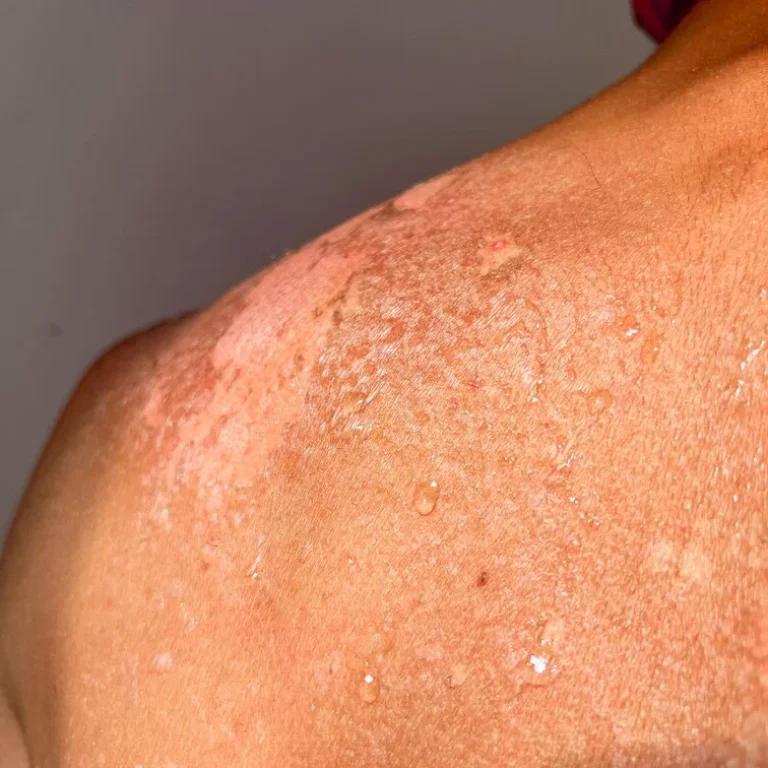 Bijwerkingen Hydrocortison