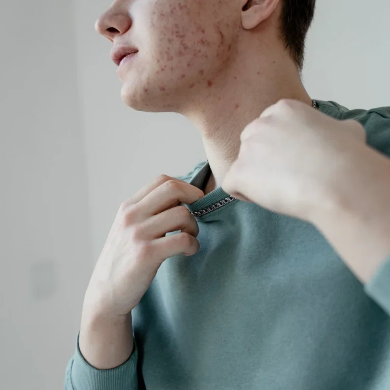 Effectieve behandelingen acne