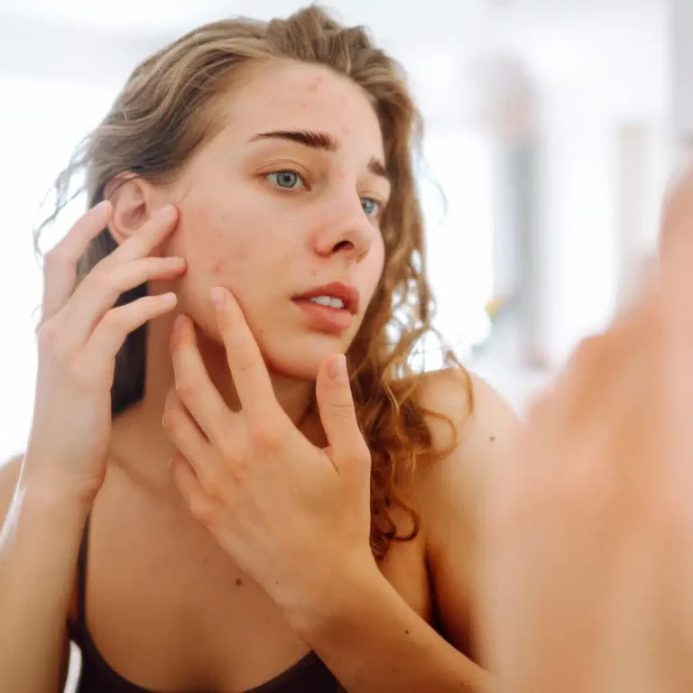 Hoe werkt Isotretinoïne?