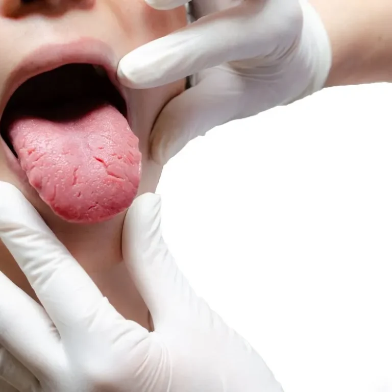 Veelvoorkomende tongaandoeningen