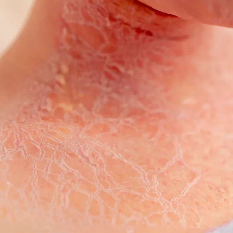 Voordelen Hydrocortison