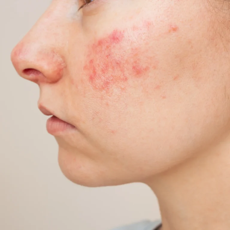 Voordelen Isotretinoïne